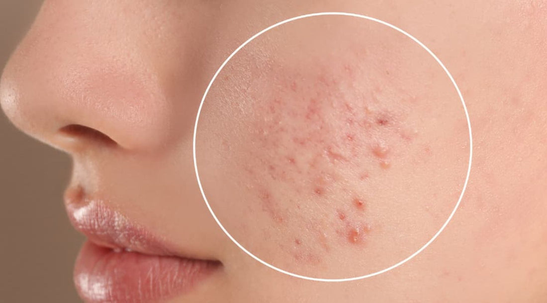 Does Red Light Therapy Help Acne