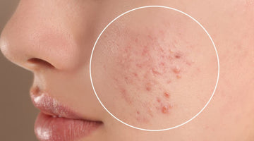 Does Red Light Therapy Help Acne