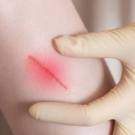 Improving Chronic Wound Healing with LED Phototherapy，prungo