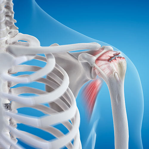 How to Heal a Torn Rotator Cuff Naturally